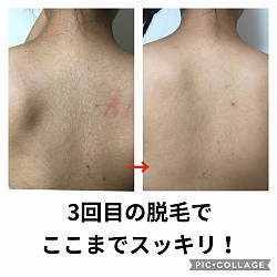 脱毛ビフォーアフター