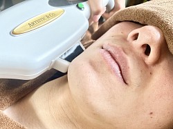 髭脱毛