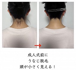 うなじ脱毛
